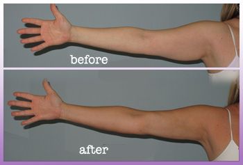 Before and after liposuction on the arms. For a nice tight and contoured look. Body Surgery, Hypertrophic Scars, Rhinoplasty Before And After, Rhinoplasty Surgery, Facial Anatomy, Cool Sculpting, After Pictures, Nose Job, Loose Skin