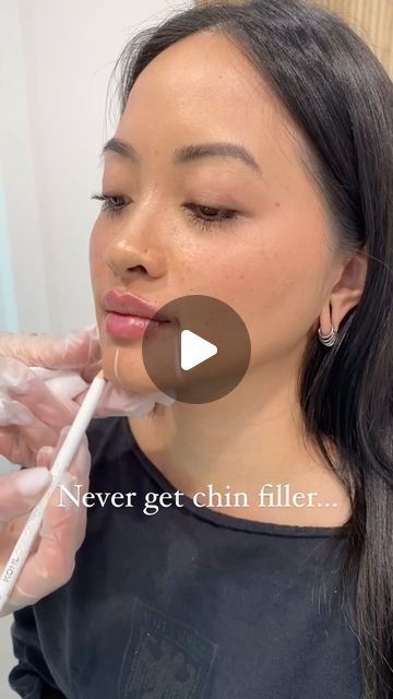 Vanity Look Skin Center | Los Angeles Medspa | LA on Instagram: "Thinking about chin filler? Here’s what you need to know! 💉✨

Chin filler can do wonders for facial balance and profile enhancement, but only when done thoughtfully. Simply adding filler to the chin without considering the surrounding areas can lead to an unnatural look. This is why framing is essential! 

Proper framing with additional filler around the chin helps to create a smooth, balanced contour that enhances your features without the risk of the dreaded ‘witch chin’ effect.

When choosing your injector, make sure they’re experienced and skilled in facial harmony. A great injector will assess your entire facial structure, not just the chin, to ensure your results look seamless and natural. Remember, it’s about enhancin Chin Fillers Before After, Facial Harmony, Facial Balancing, Chin Filler, Facial Structure, Skin Center, Facial Fillers, Anti Aging Treatments, Double Chin