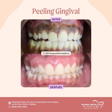 La pigmentación melánica o melanìnica es una condición frecuente y fisiológica, causada por un deposito excesivo de la melanina. En esta paciente se realizó una melanoplastia o peeling gingival, procedimiento sencillo y de breve tiempo, se realiza con anestesia local, por lo que no presenta ningún trauma o dolor para el paciente y quedan resultados excelentes. #peeling #melanoplastia