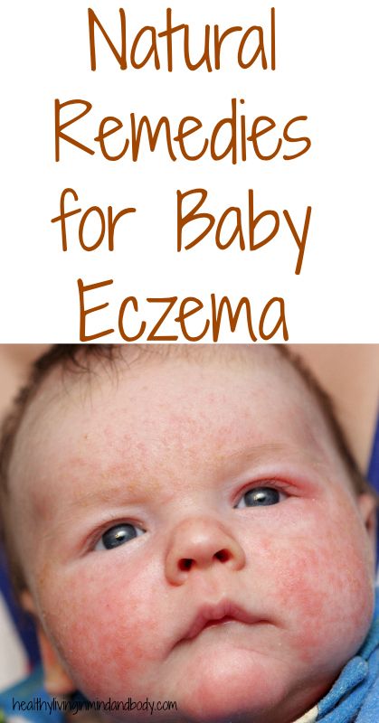 Natural Remedies for Eczema Newborn Rash, Newborn Tips, Itchy Rash, Cradle Cap, Baby Care Tips, 1st Year, Nurse Practitioner, Baby Development, Baby Skin