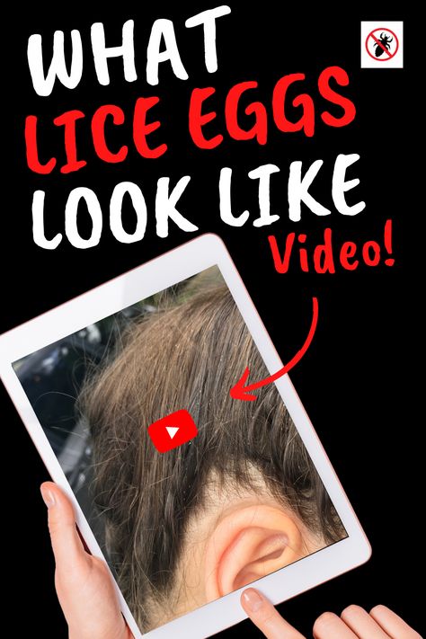 This VIDEO tutorial teaches you nine simple tricks to spot and identify lice eggs (also known as “nits”) within seconds. Whether you’re checking your child for lice or full-on “nitpicking,” here are my top tips for identifying lice eggs quickly. One of the most misunderstood things about lice is what lice eggs and nits really look like. Don't be confused, watch the video! #myliceadvice #whatnitslooklike #whatliceeggslooklike Terrestrial Animals, Lice Nits, Hair Lice, Low Sugar Diet Recipes, Lice Eggs, Head Louse, Like Video, Hair Solutions, Unwanted Hair Removal