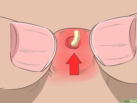 How to Instantly Get Rid of a Pimple (Cotton Ball Popping Method) Cheek Pimples, Pimples On Buttocks, Banana Mask, Cystic Pimple, Blind Pimple, Pimples Under The Skin, Zits Popping, Pimples Remedies, Prevent Pimples