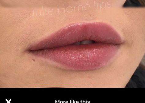 Rounded Lip Filler, Round Cupids Bow, Round Lip Filler, Round Cupids Bow Lips, Round Lips Filler, Rounded Cupids Bow Lips, Hip Filler, Lips Ideas, Cupids Bow Lips