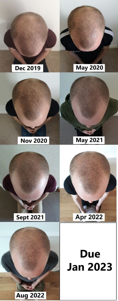 I’ve been losing my hair since the age of 25 and at 32 I started to do something about it. I was aware of the popular hair regrowth solutions like Minoxidil but I wanted to trial some of the other home remedies shown to be effective. Popular Hair, Hair Regrowth, Popular Hairstyles, Do Something, The Age, My Hair, Home Remedies, Hair Growth, Something To Do