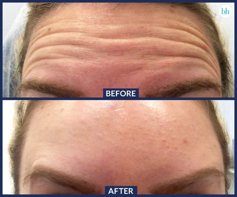 Before And After Botox Pictures, Botox Before After, Dry Hand Skin, Cosmetic Fillers, Botox Before And After, Esthetician Marketing, Teeth Whitening Remedies, Laser Teeth Whitening, Teeth Whitening System