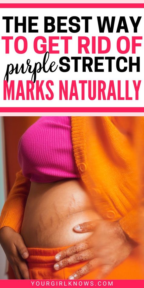 Looking for Purple stretch marks remedies at home? Here's a detailed guide on how to remove stretch marks naturally and make the process faster. You'll find how to get rid of stretch marks, how to prevent stretch marks, natural remedies to remove stretch marks, best way to remove stretch marks, best products for stretch marks, and everything you'll ever need. Strech Marks Removal, Stretch Mark Removal Cream, Strech Marks, Stretch Mark Remedies, Wellness Mama, Stretch Mark Cream, Stretch Mark Removal, Grooming Tips, Pregnancy Care