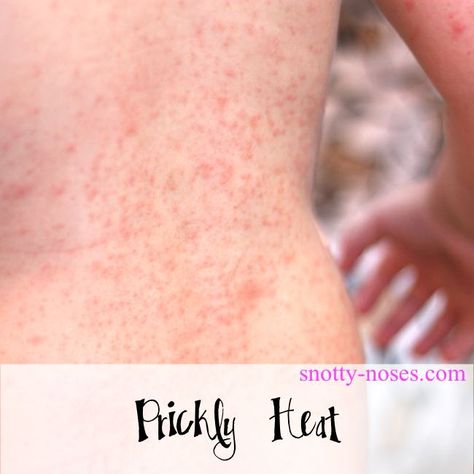 Prickly Heat Rash in Children by a pediatrician Remedies For Heat Rash, Heat Rash On Face, Treating Heat Rash, Skin Rash Remedies, Heat Rash Remedy, Baby Heat Rash, Home Remedies For Rashes, Prickly Heat Rash, Baby Skin Rash