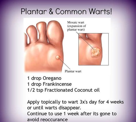 Natural Help for Warts. OnGuard essential oil is also helpful. www.greenlivingladies.com www.mydoterra.com/glutenfree Essential Oils Warts, Oregano Oil Benefits, Terra Essential Oils, Essential Oil Remedy, Yl Oils, Oil Remedies, Oregano Oil, Yl Essential Oils, Young Living Oils