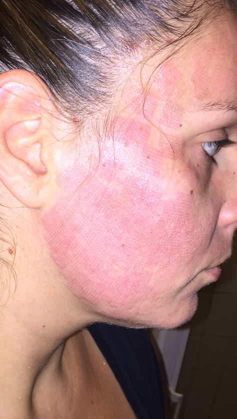 Face Slap, Swollen Face, Acne Scaring, Side Of Face, Strep Throat, Red Face, Turmeric Benefits, How To Treat Acne, Holistic Health