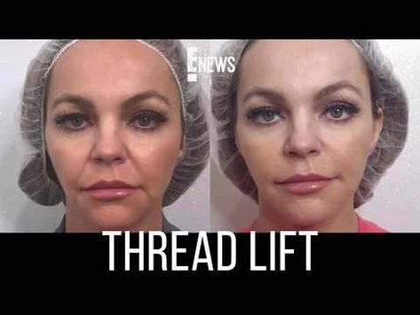 Thread Lift Face, Celebrity Skincare, Skin Removal Surgery, Mini Face Lift, Face Threading, Nurse Jamie, Eyebrow Lift, Celebrity Skin Care, Face Lift Surgery