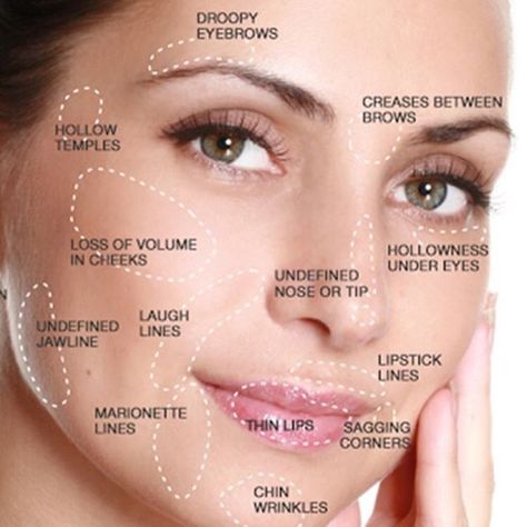 The days of going “under the knife” to achieve a facelift, chin augmentation, cheek enhancement, nose job, lip augmentation, etc. are long gone! With the advent of dermal fillers and other non-invasive procedures, we can now recreate contoured cheeks, enhance a weak chin, fill under eye hollows, give you a sharper jawline and much more in 15-20 minutes and no downtime! There are two main factors involved in the aging process causing patients to seek surgery: 1) Loss ... Chin Wrinkles, Facial Injections, Derma Fillers, Liquid Facelift, Face Fillers, Facial Anatomy, Cheek Fillers, Facial Fillers, Face Mapping