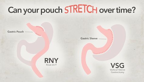 Stomach Stretches, Pouch Reset, Gastric Bypass Diet, Gastric Bypass Recipes, Vertical Sleeve Gastrectomy, Gastric Problem, Bariatric Sleeve, Pediatric Surgery, Bariatric Friendly Recipes