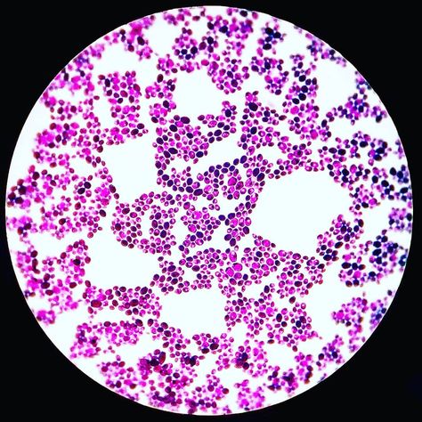 Candida albicans Gram stain. 10 Things, Measure Bra Size, Candida Albicans, The Patient, Microbiology, Anti Social, Yeast, Biology, Stain