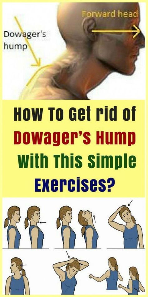 Dowagers Hump, Dowager's Hump, Neck Hump, Bolesti Chrbta, Neck Exercises, Posture Exercises, Simple Exercises, Yoga Sequences, Back Exercises