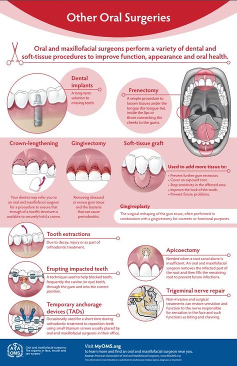 While there are some commonly known oral surgeries, there are also less commonly known! Renectomy, Crown-lengthening, Gingivectomy, Soft Tissue Grafts, Tooth Extractions, Erupting Impacted Teeth, Temporary Anchorage Devices (TADs), Apicoectomy, Trigeminal Nerve Repair. Dental Assistant Study, Oral Maxillofacial, Kesehatan Gigi, Kedokteran Gigi, Dental Hygiene School, Dentistry Student, Oral Surgeon, Gum Care, Teeth Care