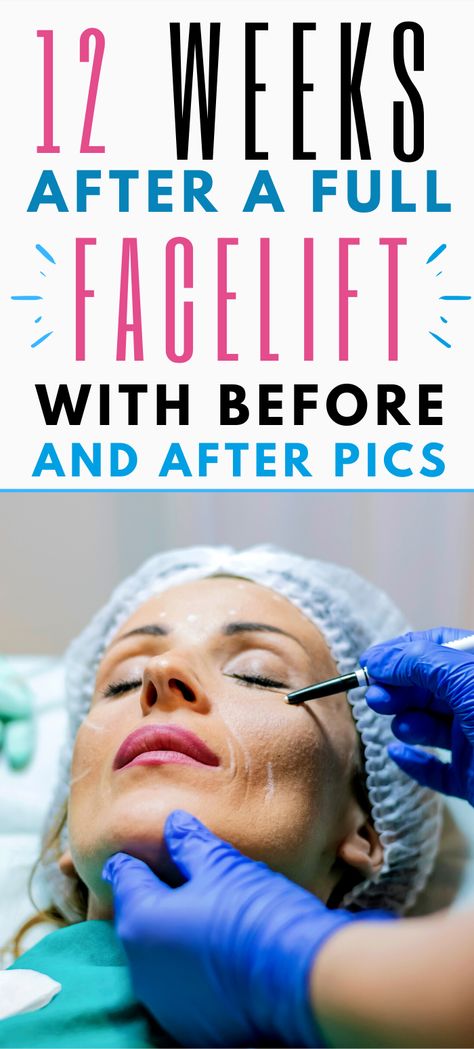 The finale, Part 4, of Erin's facelift journey, shows the before and afters of her facelift 12 weeks post-surgery. Plus, she dishes on all the things she learned and the best tips if you're looking to have some cosmetic surgery done. #cosmeticsurgery #facelift #plasticsurgery #skincare Facelift Recovery Day By Day, Facelift Recovery, Facelift Before And After, Plastic Surgery Fail, Plastic Surgery Gone Wrong, Face Lift Surgery, Face Wrap, Facial Surgery, Celebrity Plastic Surgery