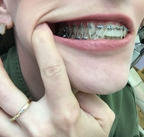 #braces #braceface #metalbraces #girlswithbraces #elastics Brackets Aesthetic, Cute Braces Colors, Braces Elastics, Adult Braces, Braces Girls, Cute Braces, Face Angles, Clear Braces, Brace Face