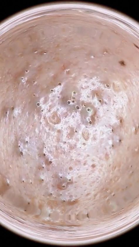 pimples popping video  #ance #squeeze #squeezepip #satisfying #acne #fyp #beauty #pimpleacne #foryou Pimple Poppìng Videos Satisfying, Pimple Poppìng Videos, Pimple Poppìng, Big Zits, Closed Comedones, Pimple Popper Videos, Pimple Pop, Popping Pimples, Skin Blackheads