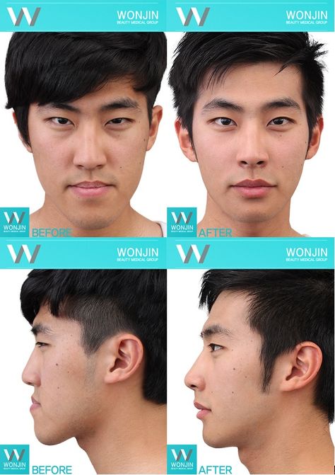 What is total maxillofacial (two jaw) surgery?Usually someone with an advanced jaw line has their cheekbone protrude as well. In this case, normal square jaw or cheekbone reduction surgery alone is not enough to provide slimming effects. WONJIN’s total maxillofacial or face contour surgery not only deals with slimming the face contouring but creates slender jaw line reduction and a youthful appearance. #wonjin #beauty #cosmetic #PlasticSurgery #TwoJaw Cheekbone Reduction, Nose Plastic Surgery, Square Jaw, Plastic Surgery Korea, Orthognathic Surgery, Korean Plastic Surgery, Rhinoplasty Nose Jobs, Head Anatomy, Jaw Surgery