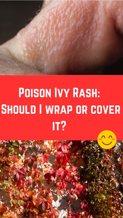 Poison Ivy Rash: Should I wrap or cover it? (What to do) How To Treat Poison Ivy, Home Remedy For Poison Ivy Rash, How To Get Rid Of Poison Ivy Rash, Get Rid Of Poison Ivy Rash Fast, How To Dry Up Poison Ivy Rash, How To Treat Poison Ivy Remedies, Poison Ivy On Skin, Poison Ivy Rash Pictures, Poison Sumac Rash