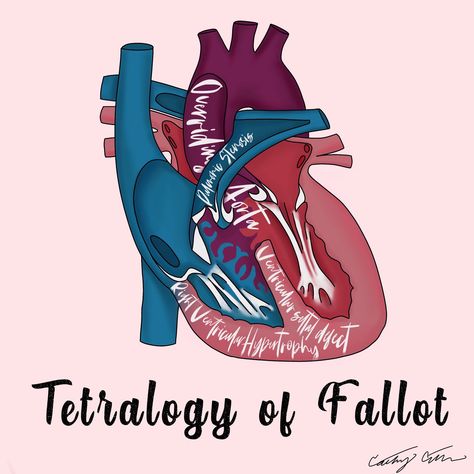 Cardiac Surgeon Wallpaper, Tetralogy Of Fallot Tattoos, Tetralogy Of Fallot Quotes, Chd Awareness Quotes, Heart Surgery Quotes, Pediatric Cardiologist, Pediatric Cardiac Nursing Congenital Heart Defect, Tetralogy Of Fallot, Chd Babies