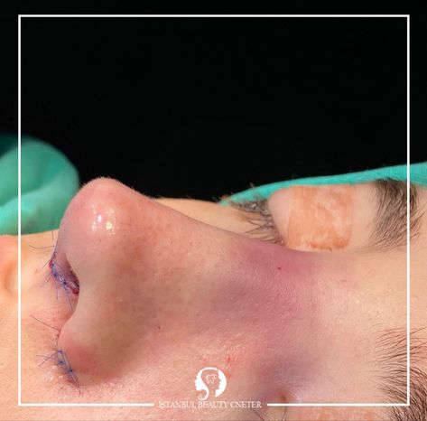 If you are unhappy with the shape of your nose or have trouble breathing And you are looking for a suitable place, so contact one of our consultants and complete your information about rhinoplasty or rhinoplasty and benefit from the experiences of our doctors. Practice_bini_darastanbul #Surgery #nose #nose_operation #nose_beauty_operation #Nose_form #nose_shape #nose_surgery #rhinoplasty #rhinoplasty #Bani #Aesthetics_Bini #Beauty_of_Facial #Practice_Bini_In Ist Nose Operation, Surgery Nose, Nose Surgery, Nose Shapes, Beauty Center, Shape Of You, The Shape, Surgery, Istanbul