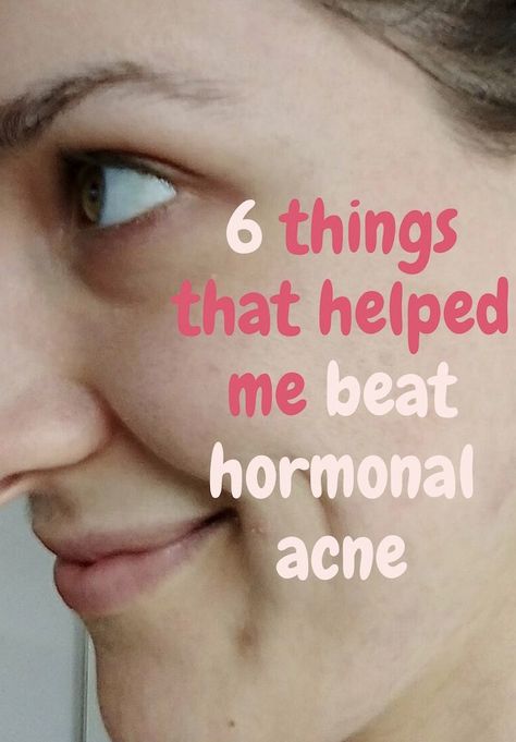 Chin Acne How To Get Rid Of, Clear Acne Overnight, Cystic Acne On Chin, Medical Remedies, Treating Cystic Acne, Chin Acne, Cystic Acne Remedies, Acne Diet, Bad Acne