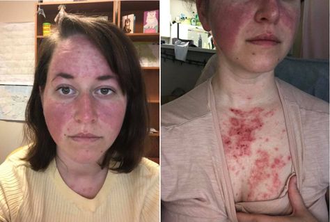 23 Honest Photos of the 'Embarrassing' Sides of Autoimmune Disease We Don't Talk About Rash On Face, Autoimmune Disease Symptoms, Dairy Free Breastfeeding, Rare Disorders, Sjogrens Syndrome, We Dont Talk, Rare Disease, Skin Diseases, Chronic Fatigue