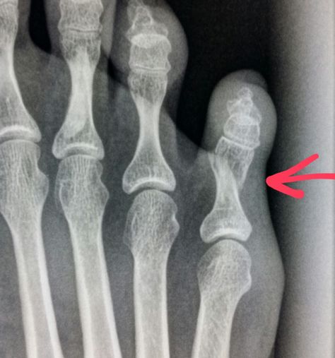 #Xray of #foot shows a #toe #fracture. #radiologist #radiology #trauma Hip Xray, Broken Finger Xray, Ribs X Ray Anatomy, Chest X Ray Radiology, Chest X Ray Interpretation, Diagnostic Imaging, Medical Imaging, Radiology, X Ray