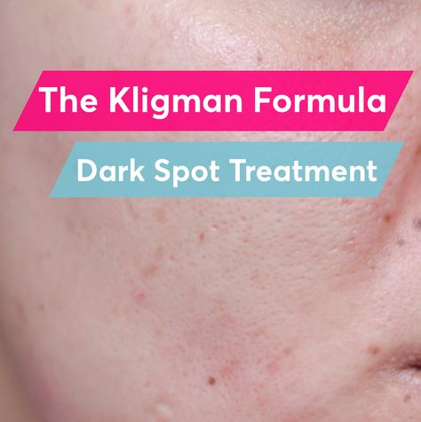 One of the most common cosmetic skin concerns is dark spots on the skin. The dermatologist gold-standard formula for treating hyperpigmentation is the Kligman formula...but does it work? Skin Darkening, Acne Dark Spots, Treating Hyperpigmentation, Post Inflammatory Hyperpigmentation, Dark Spot Corrector, Fade Dark Spots, Dark Spots On Skin, Remove Dark Spots, Azelaic Acid