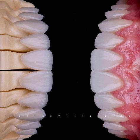 Dental Morphology, Tooth Bridge, Dental Ceramics, Esthetic Dentistry, Dental Images, Dental Restoration, Dental Videos, Dental Photography, Veneers Teeth