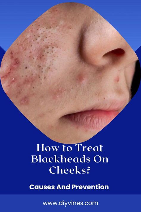 Do you want to know How To Treat big blackheads on cheeks? big blackheads on cheeks are blackish or yellowish bumps and are basically a kind of acne vulgaris. How To Treat Blackheads, Blackheads On Cheeks, Skin Blackheads, Blackhead Remedies, Prevent Pimples, Acne Vulgaris, Losing 40 Pounds, Cold Sores Remedies, How To Get Rid Of Pimples