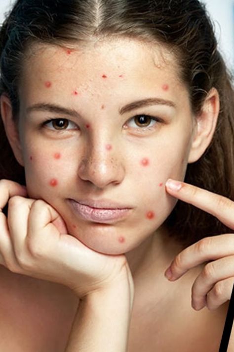 Acne Images, Acne Photography, How To Hide Pimples, Pimple Face, Acne Pictures, Lemon Face Mask, Acne Overnight, Photoshop Youtube, Pimples On Face