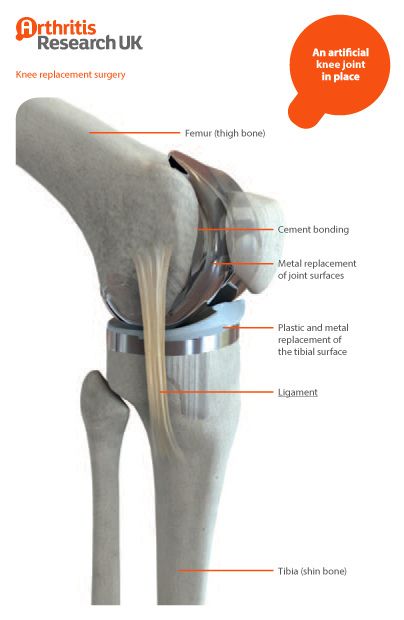 An artificial knee joint in place by Arthritis Research UK, via Flickr Knee Anatomy, Orthopedic Surgeon, Knee Replacement Surgery, Spine Surgery, Knee Pain Relief, Knee Surgery, Knee Replacement, Success Rate, Knee Pain