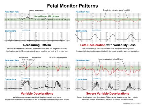 Fetal Monitoring VEAL CHOP Variable decelerations…..Cord compression Early decelerations………Head compression Accelerations…………….OK, may need Oxygen Late decelerations……….Placental Insufficiency Maternal Nursing, Fetal Monitoring, Fetal Heart Rate, Nurse Teaching, Newborn Nursing, Veal Chop, Ob Nurse, Child Nursing, Ob Nursing