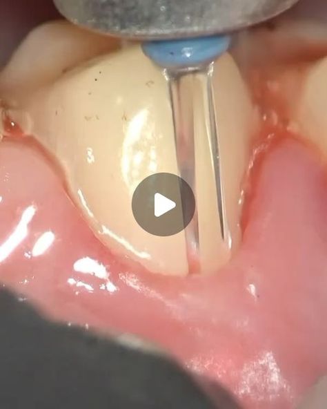 Dentistry on Instagram: "By @dr.nazarbm Top 3 procedures I do with @waterlase_laserdentistry laser:
1. Removal of crowns and veneers.
2. Flap less crown lengthening.
3. Soft tissue correction." Crown Lengthening, Dental Crown Procedure, Crown, On Instagram, Instagram