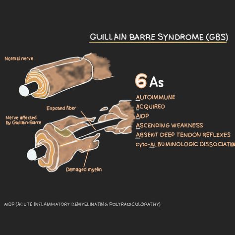 Guillain-Barre syndrome is a rare disorder in which your body's immune system attacks your nerves. Weakness and tingling in your hands and feet are usually the first symptoms. These sensations can quickly spread, eventually paralyzing your whole body. #art #medical #ibd #medicine #mnemonic #health #doctor #healthy #medstudent #medschool #premed #medicalschool #doctors #medicalstudent #surgery #hospital #surgery #motivation #guillain-barre-syndrome Surgery Motivation, Hospital Surgery, Guillain Barre, Guillain Barre Syndrome, Rare Disorders, Pre Med, Med Student, September 2022, Med School