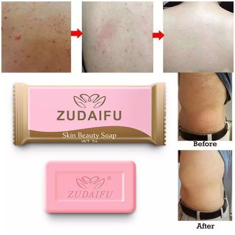 Look what I found on AliExpress Soap Notes, Clearing Acne, Different Types Of Acne, Sulfur Soap, Acne Lotion, Skin Clearing, Cleansing Skin, Body Cleansing, Itching Skin