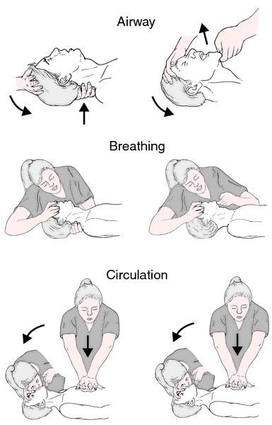 Cardiopulmonary arrest (CPA) | definition of cardiopulmonary arrest (CPA) by Medical dictionary Anesthesia School, Advanced Cardiac Life Support, Medical Assistant Student, Breath Sounds, Medical Dictionary, Cardiopulmonary Resuscitation, Basic Life Support, Medicine Notes, Medical School Life