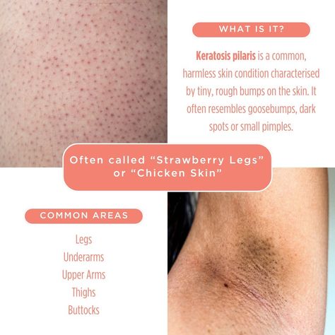 What is Keratosis Pilaris? 🤔🍓⁠ ⁠ Keratosis Pilaris, or "Strawberry/Chicken Skin," is a common skin condition that causes tiny, rough bumps on the arms, legs, and underarms. It's caused by dead skin cells clogging hair follicles, leading to these small bumps. ⁠ ❓ How does it happen?⁠ It occurs when keratin, a skin protein, builds up and blocks hair follicles, creating small bumps that may appear red or inflamed. ⁠ ❓ What causes it?⁠ 🏾 Dry Skin: It tends to be worse in people with dry s... Pilaris Keratosis, Strawberry Chicken, Small Pimples, Strawberry Legs, Clean Blackheads, Keratosis Pilaris, Chicken Skin, Acne Solutions, Skin Condition