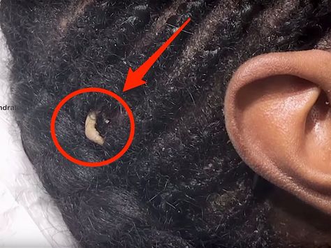 Dr. Pimple Popper found a bizarre growth like a fingernail on a patient's head Pimple Inside Nose, Huge Pimple, Head Pimples, Ear Pimple, Pimple Popper Tool, Honey Face Cleanser, Blind Pimple, Pimples Under The Skin, Makeup Life Hacks