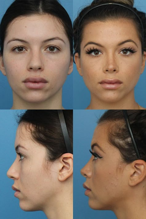 Plastic Surgery Before And After Face, Rhinoplasty Before And After Front View, Nose Plastic Surgery Before After, Rynoplasty Surgery, Alarplasty Before After, Nose Tip Surgery Before After, Nose Surgery Before And After, Rhinoplasty Front View, Subtle Rhinoplasty