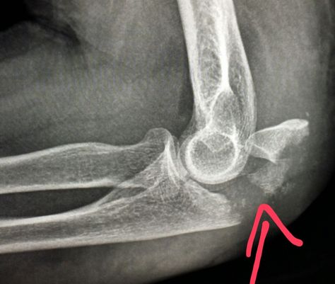 Elbow xray shows a fracture of the ulna (olecranon) in a patient who fell. #radiologist #radiology #trauma #pain Elbow Xray, Xray School, Studying Nursing, Radiology Schools, Xray Humor, Radiology Technician, Forensic Anthropology, Nuclear Medicine, Xray Tech