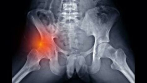 Femoroacetabular Impingement (FAI) – Plus Femoroacetabular Impingement, University Of Nottingham, Post Surgery, Surgery