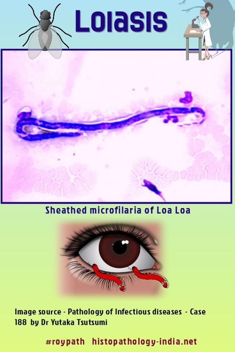 Eye Worm, Townhouse Decorating, The Peripheral, Kidney Damage, Central Africa, Medical Knowledge, Disease, Medical