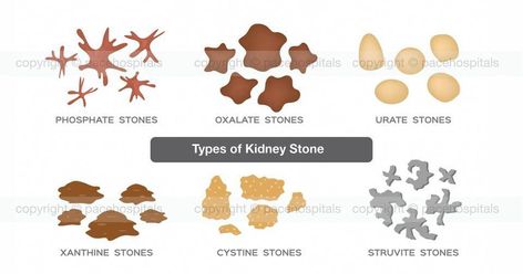 A kidney stone may not cause symptoms until it moves around within your kidney or passes into your ureter. Kidney stones that can Kidney Stone Pain Relief, Kidney Problems Signs, Autoimmune Diet Plan, Estrogen Rich Foods, Benefits Of Baking Soda, Survival First Aid, Coconut Oil Skin, Survival First Aid Kit, Baking Soda For Hair