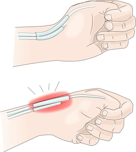 Thumb Pain: What is De Quervain's Tendinosis & How Do You Fix It? – Brookfield Chiropractor Arthritic Thumb Relief Remedies, Thumb Exercises, Thumb Pain Relief, Broken Thumb, Hand Therapy Exercises, Carpal Tunnel Exercises, Body Pressure Points, Wrist Pain Relief, Thumb Splint