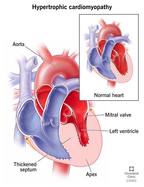 Heart Chambers, Chambers Of The Heart, Heart Structure, Subarachnoid Hemorrhage, Tricuspid Valve, Types Of Strokes, Heart Diagram, Mitral Valve, Blood Pressure Control