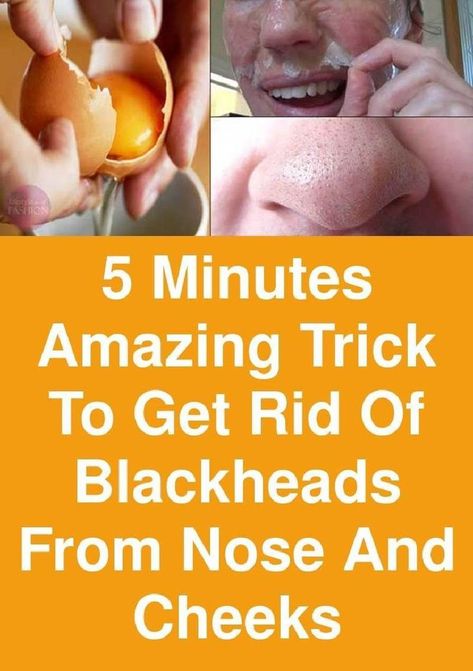 Use This Simple And Effective Trick And Get Rid Of Blackheads! Blackheads On Cheeks, Pore Cleaning, Mint Toothpaste, Rid Of Blackheads, Clean Blackheads, Home Beauty Tips, Health Tips For Women, Get Rid Of Blackheads, Skin Pores