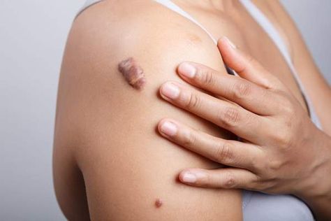 Keloid result from skin’s overreaction to injuries. Here is how to flatten keloid scars naturally, without requiring extreme treatments. Get Rid Of Keloids, Scar Remedies, Hypertrophic Scars, Natural Healing Remedies, Scar Removal, Laser Therapy, Skin Disorders, Scar Tissue, Red Colour